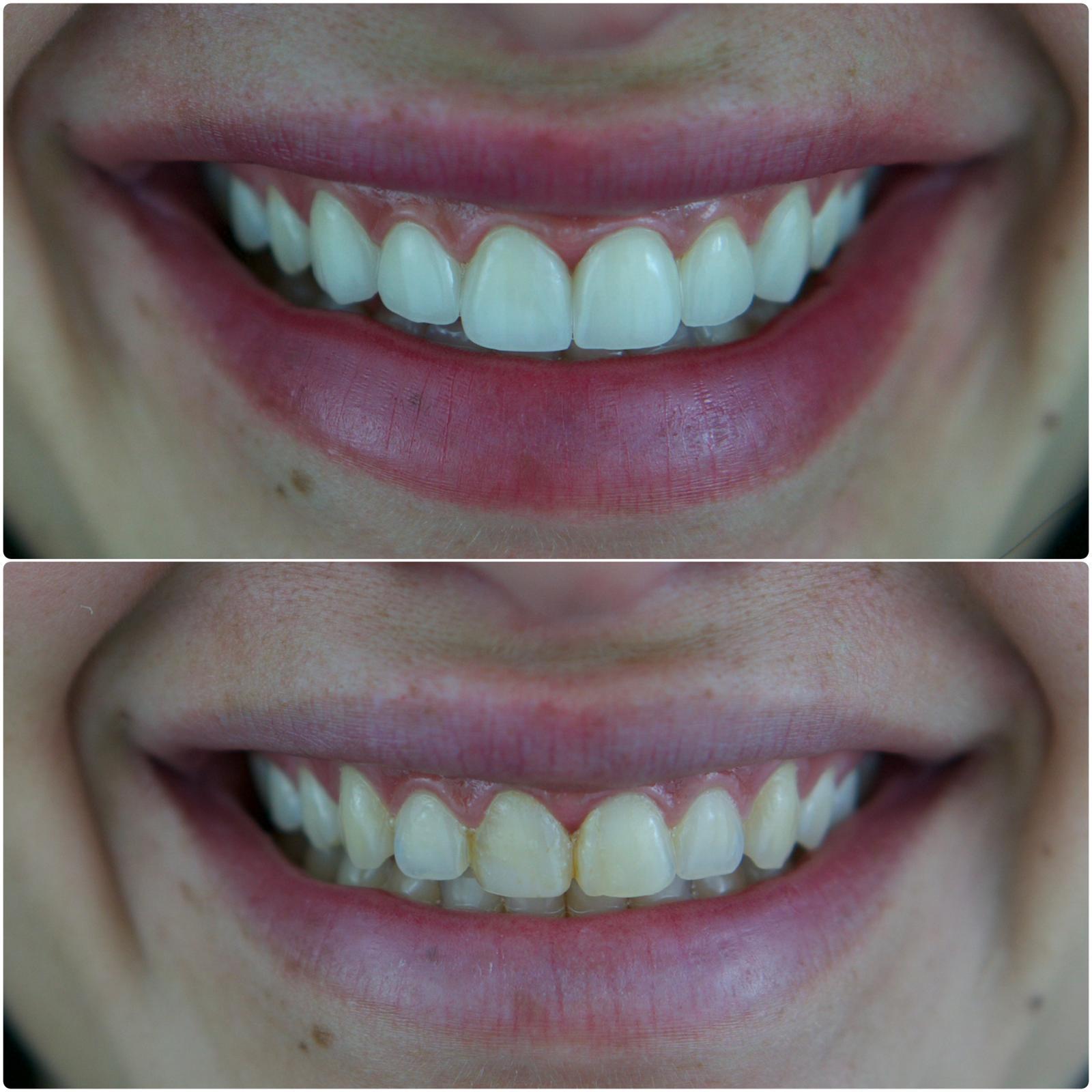 ציפויים - לפני ואחרי